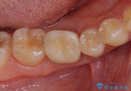 「銀歯しかできない」と言われた　奥歯のオールセラミック治療の治療中