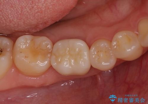 「銀歯しかできない」と言われた　奥歯のオールセラミック治療の症例 治療後