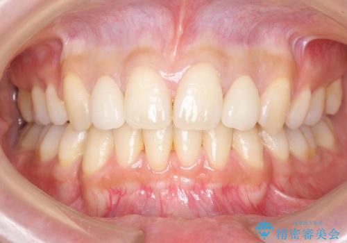 矮小歯　前歯のセラミック+矯正の治療後