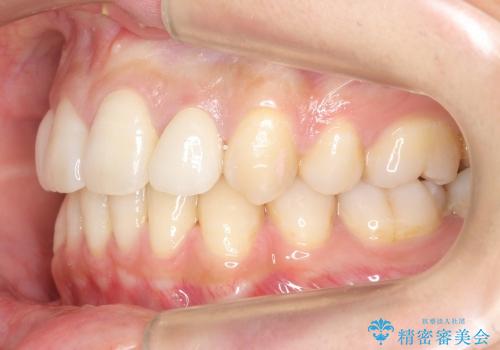 矮小歯　前歯のセラミック+矯正の治療後