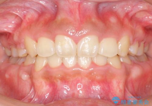 大人の出っ歯　がたがた　劇的に改善の症例 治療後