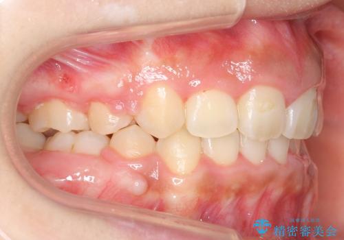 大人の出っ歯　がたがた　劇的に改善の治療後