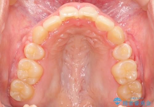 大人の出っ歯　がたがた　劇的に改善の治療後