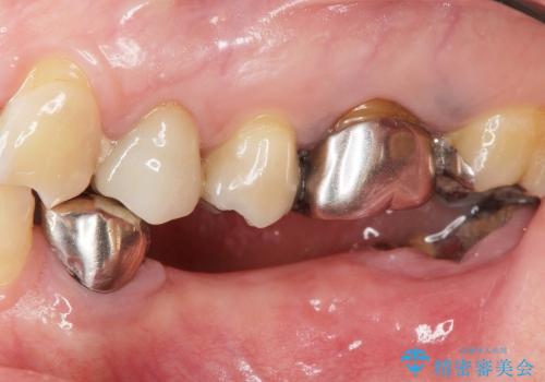 [スクリューリテイン式] インプラントによる臼歯部咬合回復の症例 治療前