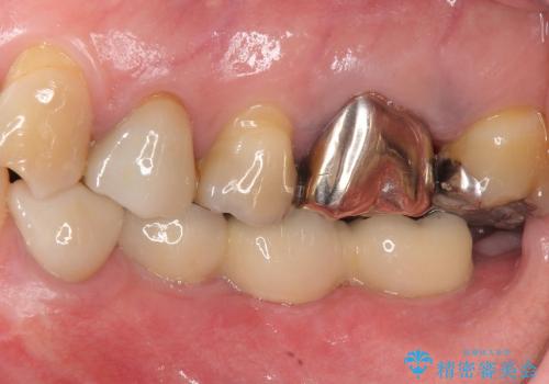 [スクリューリテイン式] インプラントによる臼歯部咬合回復の治療後