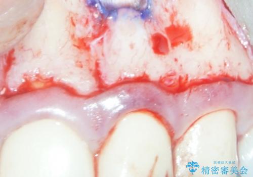 マイクロスコープを用いた外科的歯内療法により前歯の根尖病巣を治療した1例の治療中