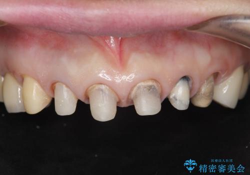 [歯ぐきの位置変化] クラウンの再作製の治療中