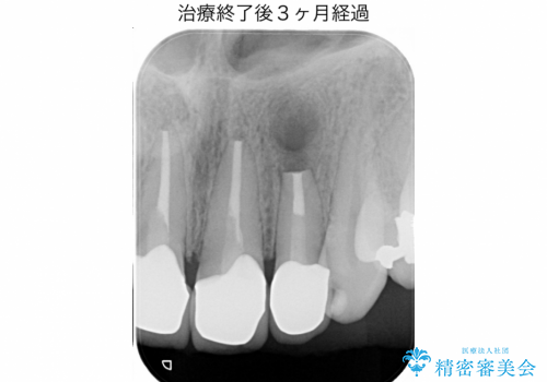 マイクロスコープを用いた外科的歯内療法により前歯の根尖病巣を治療した1例の治療後