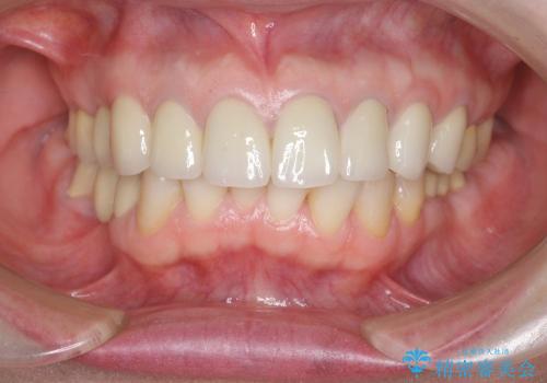 [歯ぐきの位置変化] クラウンの再作製の治療後