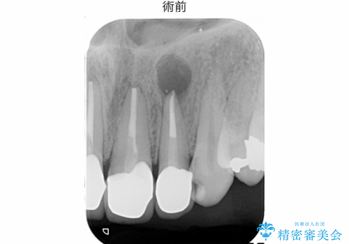 マイクロスコープを用いた外科的歯内療法により前歯の根尖病巣を治療した1例の症例 治療前