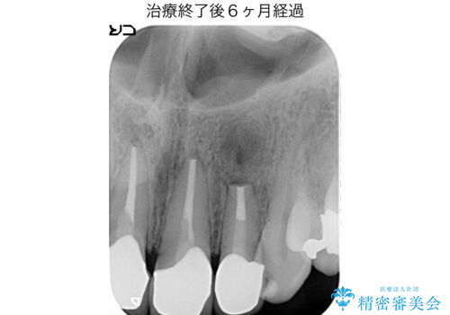 マイクロスコープを用いた外科的歯内療法により前歯の根尖病巣を治療した1例の治療後