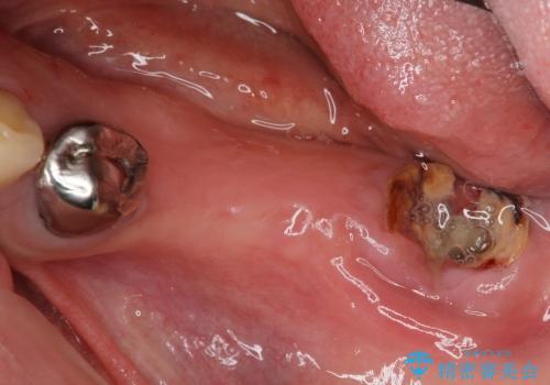 [スクリューリテイン式] インプラントによる臼歯部咬合回復の治療前