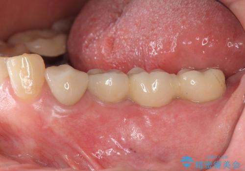 [スクリューリテイン式] インプラントによる臼歯部咬合回復の治療後