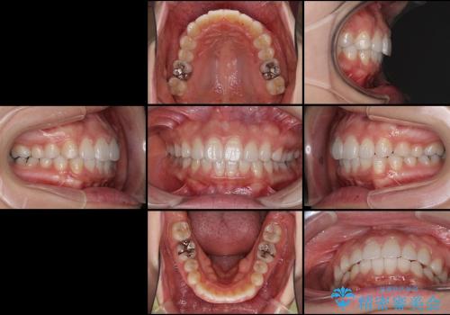 抜歯をせずに出っ歯を改善　リンガル矯正の治療後