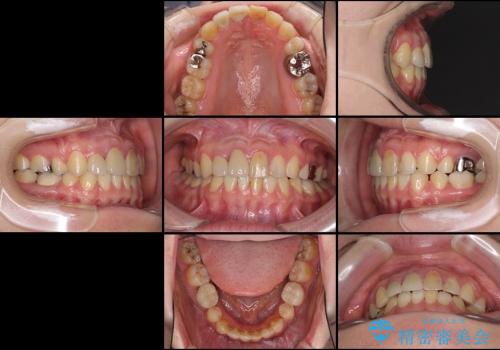 八重歯・前歯のでこぼこを治したい　抜歯矯正の治療後