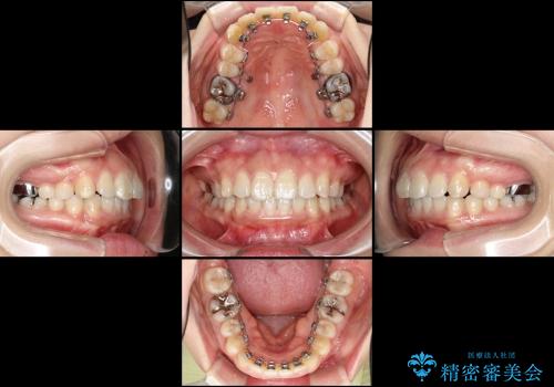 抜歯をせずに出っ歯を改善　リンガル矯正の治療中