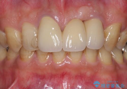 [歯の挺出] 歯周病治療と前歯ブリッジの治療後