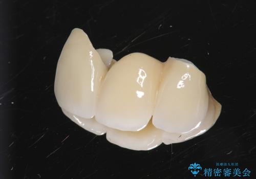 [歯の挺出] 歯周病治療と前歯ブリッジ