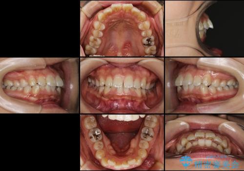 抜歯をせずに出っ歯を改善　リンガル矯正の治療前