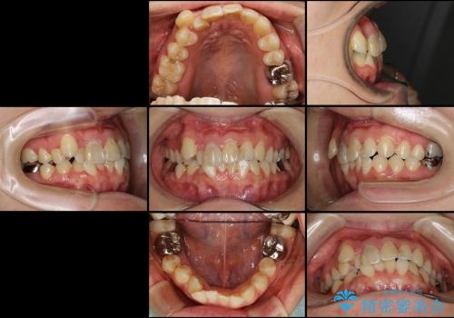 八重歯・前歯のでこぼこを治したい　抜歯矯正の治療前