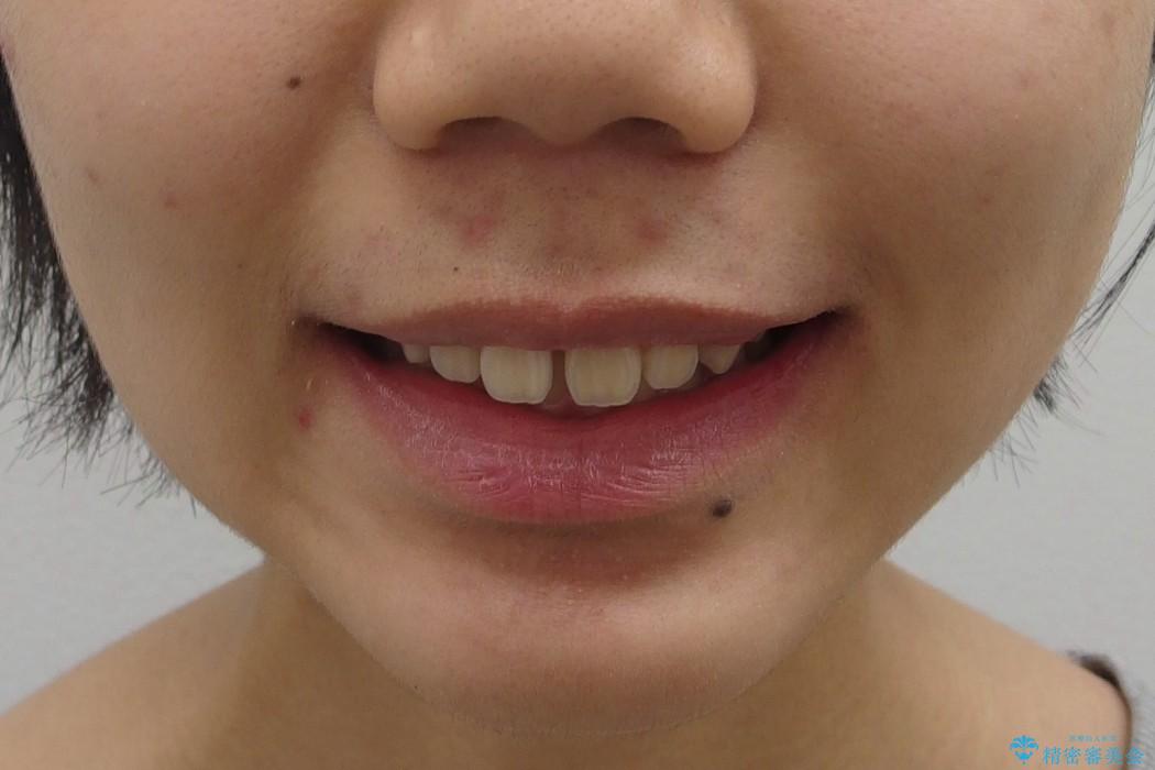 10代女子　前歯のすき間　過蓋咬合の治療前（顔貌）
