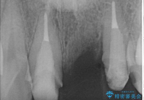[歯の挺出] 歯周病治療と前歯ブリッジの治療中