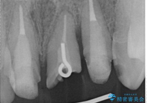 [歯の挺出] 歯周病治療と前歯ブリッジの治療中