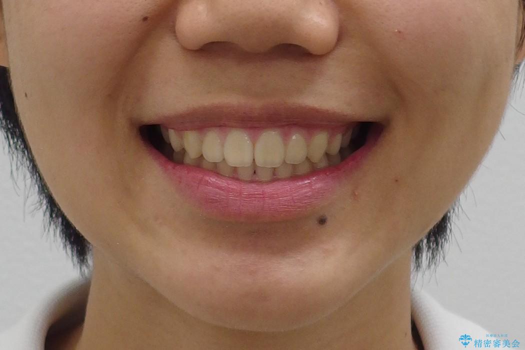 10代女子　前歯のすき間　過蓋咬合の治療後（顔貌）