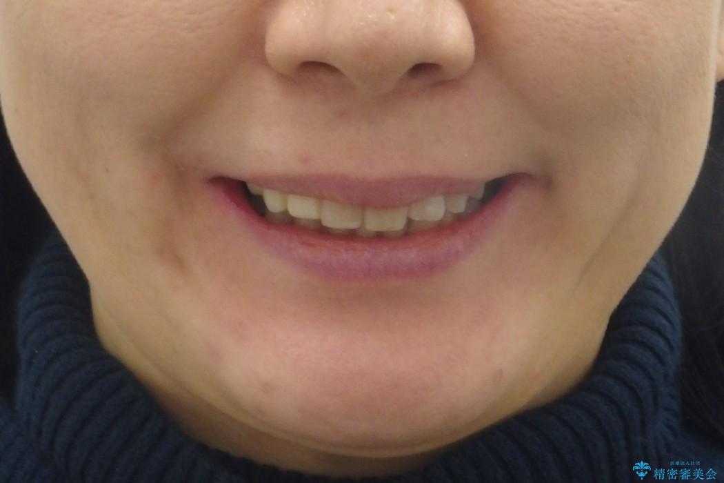 40代女性　気になる前歯だけ　上の部分矯正、セラミック　低予算での治療後（顔貌）