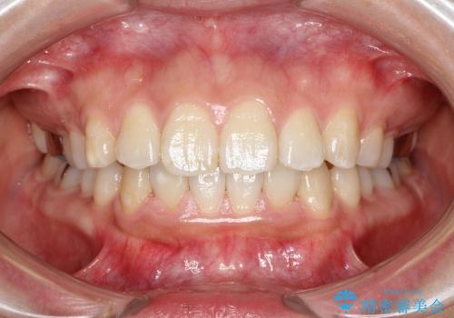 抜歯をせずに出っ歯を改善　リンガル矯正の治療中