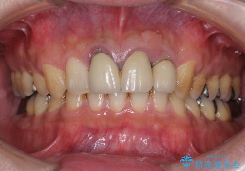 [歯の挺出] 歯周病治療と前歯ブリッジの治療前