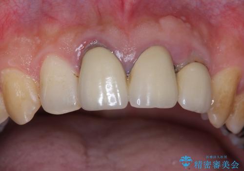 [歯の挺出] 歯周病治療と前歯ブリッジの治療前