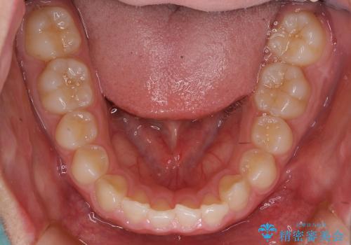 10代女子　前歯のすき間　過蓋咬合の治療中