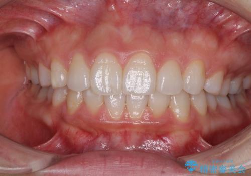 抜歯をせずに出っ歯を改善　リンガル矯正の症例 治療後