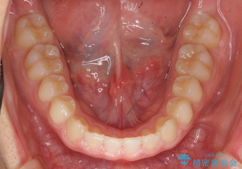 10代女子　前歯のすき間　過蓋咬合の治療後