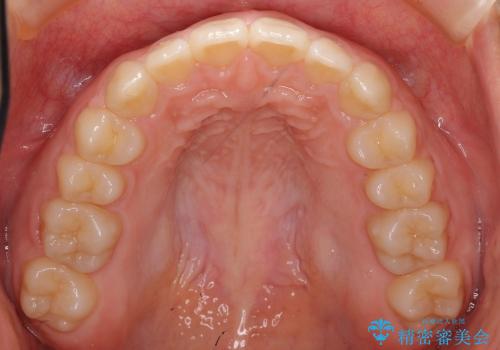 10代女子　前歯のすき間　過蓋咬合の治療後