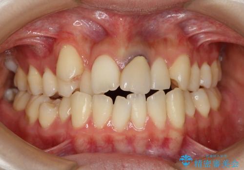 20代女性 八重歯の矯正治療の治療前