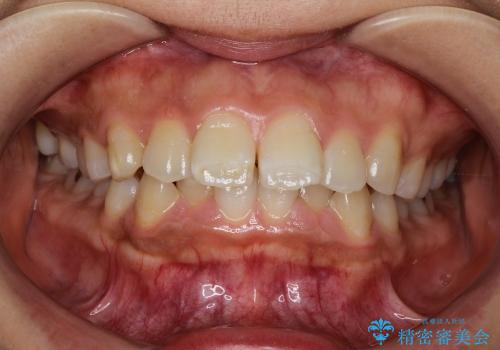 抜歯をせずに出っ歯を改善　リンガル矯正の症例 治療前