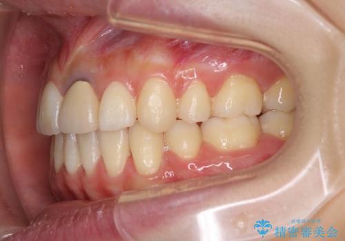 20代女性 八重歯の矯正治療の治療後