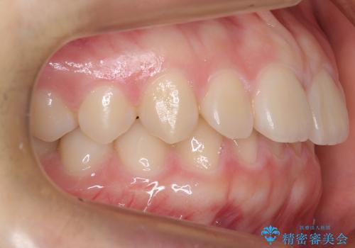 10代女子　前歯のすき間　過蓋咬合の治療前
