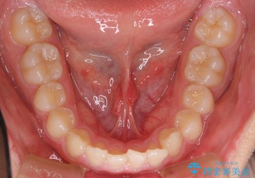 10代女子　前歯のすき間　過蓋咬合の治療前