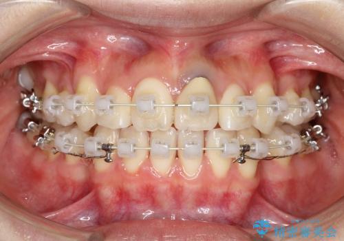 20代女性 八重歯の矯正治療の治療中