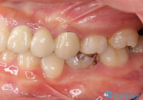 [歯周外科] 歯ぐきの状態を改善した審美ブリッジ治療の治療前