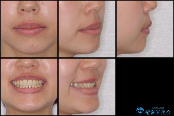 八重歯・クロスバイトの矯正治療　クリアブラケット　1年半の治療後（顔貌）