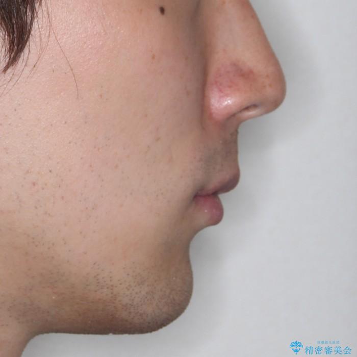 30代男性　出っ歯のワイヤー矯正の治療後（顔貌）