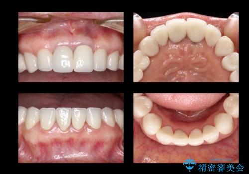 セラミックできれいな歯に　セラミックのやり変えの治療後