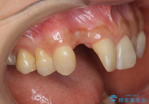 [審美義歯]  ノンクラスプデンンチャー (ウェルデンツ)の治療前
