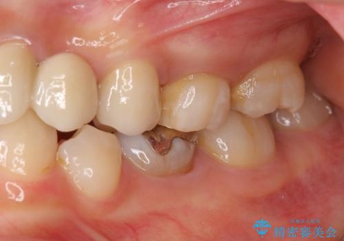 [歯周外科] 歯ぐきの状態を改善した審美ブリッジ治療の治療後