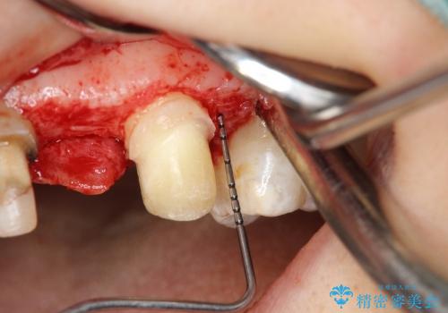 [歯周外科] 歯ぐきの状態を改善した審美ブリッジ治療の治療中