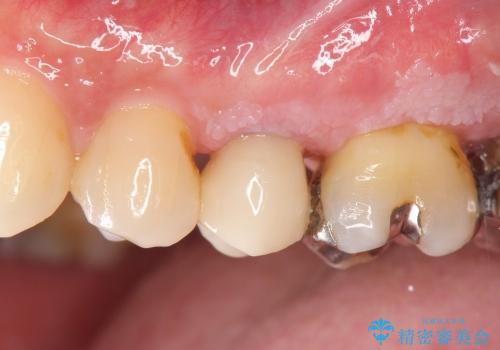 [歯牙挺出] 深い虫歯の歯を抜かずに残す治療　の治療後